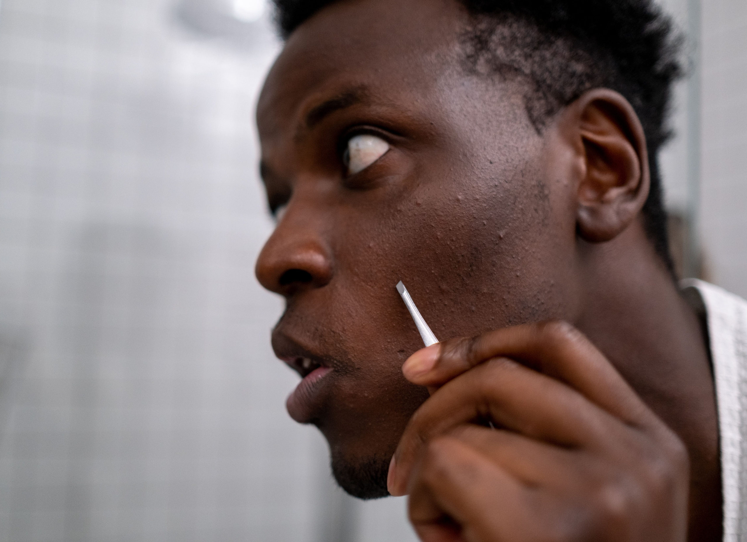dit zijn de oorzaken van acne en zo pak je het effectief aan fitplein.nl
